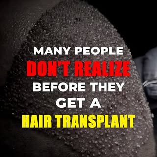 A hair transplant moves healthy hair, but it doesn’t stop future hair loss. That is why a long-term 