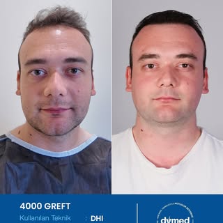 Her cerrahi veya girişimsel işlemde sonuçlar kişiden kişiye değişiklik gösterebilir. İşlem öncesinde