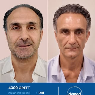 Her cerrahi veya girişimsel işlemde sonuçlar kişiden kişiye değişiklik gösterebilir. İşlem öncesinde