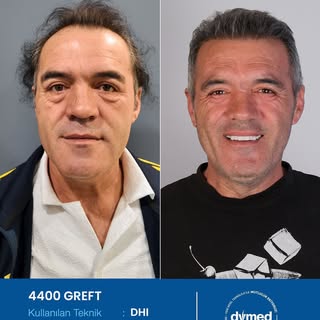 Her cerrahi veya girişimsel işlemde sonuçlar kişiden kişiye değişiklik gösterebilir. İşlem öncesinde