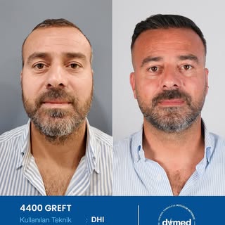 Her cerrahi veya girişimsel işlemde sonuçlar kişiden kişiye değişiklik gösterebilir. İşlem öncesinde