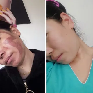 Post Inflammatory Hyperpigmentation (PIH),self experiment is very dangerous,seek medical professiona