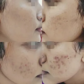 Acnemarks Before/After
.
.
#skindoctor #beforeandafter #acne #acnetreatment #pigmentation #drswetara