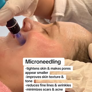 #microneedling #skinhealth #skincareroutine #nepal #dermacare