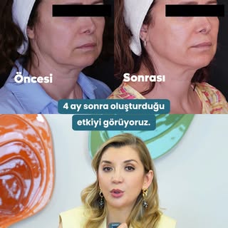 3 seans Morpheus8 uygulaması sonrası cildin genel görünümündeki değişimi öncesi & sonrası görüntüler