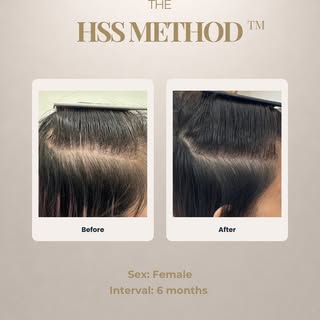 Every hair journey is different 🤍

These images show the progress of several female patients follow