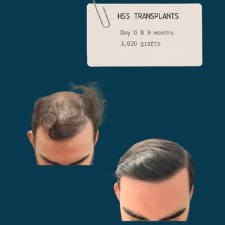 9 months post hair transplant - 3,020 grafts.

This before-and-after shows one patient’s progress at
