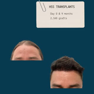 A carefully planned hairline. 2,160 grafts. 9 months of progress.

These images show this patient be