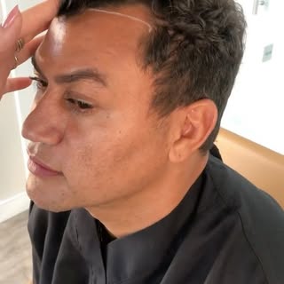 Na última Quarta-feira, @popofreitas veio até a @vincihairbrasil realizar o procedimento de transpla
