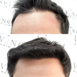 O Luan percebeu a calvície cedo.

Antes mesmo do transplante, iniciou o tratamento clínico e notou u