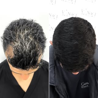 Muita gente acredita que precisa esperar a calvície piorar para fazer um transplante.
O Valdeir fez 
