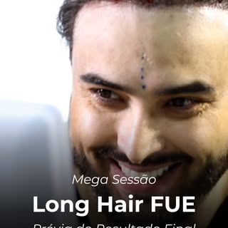 Você faria um transplante capilar se não precisasse raspar o cabelo?

Durante muito tempo, essa foi 