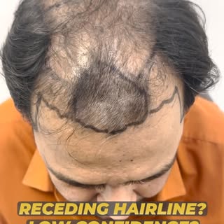 🔥 Another Amazing Hair Transplant Transformation! ✨
Nothing builds confidence like seeing real resu