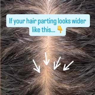 Think your hair part is widening?

It may be an early sign of hair thinning.

Comment “HAIRLOSS” and
