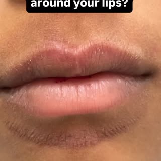 Habit → irritation → pigmentation.

This is lip lick dermatitis — a very common habit problem we see