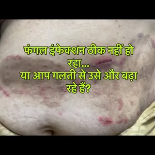 Fungal infection theek nahi ho raha?
Shayad aap treatment nahi… steroid use kar rahe ho.

Ye hi sabs