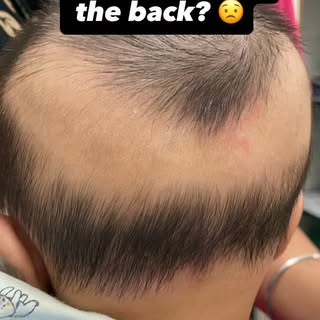 Relax… this is very common.

That patch you see is mostly due to friction —
👉 baby lying on the sam