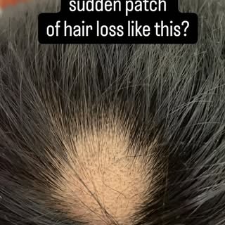 Have you ever noticed patches like these on your scalp?

Sudden round or oval areas where hair is mi