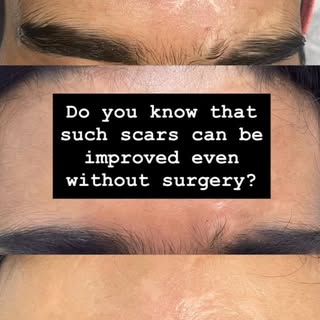 Do you know that scars can be improved even without surgery?

If your skin still feels uneven, marke