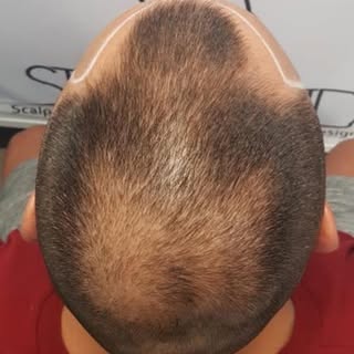 He Thought Natural SMP Was Impossible… Until He Found Scalp Ink Design 👀🔥

Our client, in his mid 