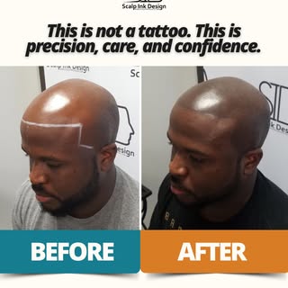 😳 From Skeptic to Smile 😍

A Natural Hairline Transformation at Scalp Ink Design

When this client