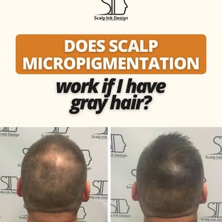 Got gray hair? That is absolutely no problem.

Scalp Micropigmentation (SMP) is carefully designed t