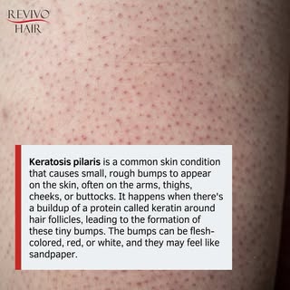 Keratosis pilaris is a common skin condition that causes small, rough bumps to appear on the skin, o