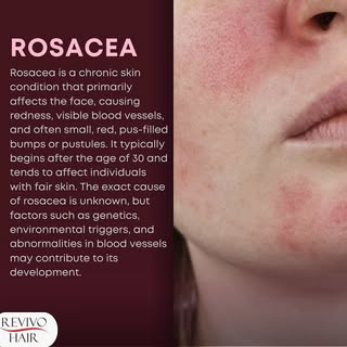 Rosacea is a chronic skin condition that primarily affects the face, causing redness, visible blood 
