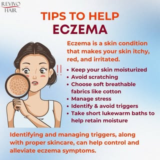 Eczema is a skin condition characterized by inflammation, redness, and itching. It often involves pa