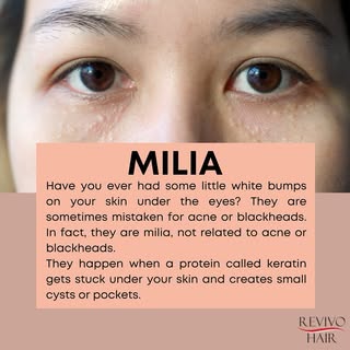 Milia are small, white or yellowish bumps that often appear on the skin, commonly on the face. They’