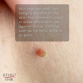 Skin tags are small, soft growths on the skin’s surface. They often look like tiny, hanging bits of 