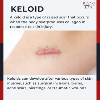 A keloid is a type of raised scar that occurs when the body overproduces collagen in response to ski