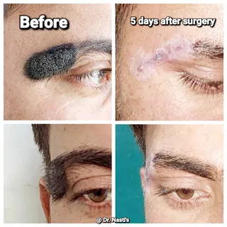 Giant Nevus Done and Dusted..
Eyebrow will be transplanted soon.. 
#anantnag #srinagar #srinagar #ka