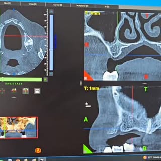 Precision begins before the implant is placed. 🦷✨
With CBCT-guided implant planning, we assess bone