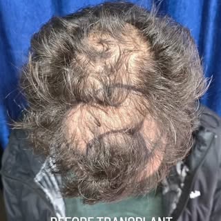 From thinning to thriving 💇‍♂️
Advanced hair transplant solutions for a fuller, natural hairline.
#