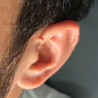 ✨ Say Goodbye to Skin Tags — Safely & Professionally! ✨
Skin tags are harmless, but they can be irri