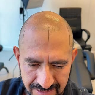 Nuevo resultado de micropigmentación capilar ✨

La micropigmentación crea el efecto de un cabello má