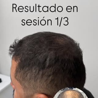 Sesión número 1 de 3 que les parece ? #pigmenta #micropigmentacióncapilar