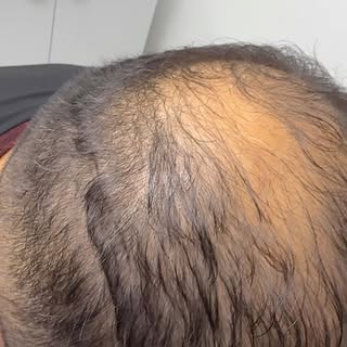 Nuevo caso de efecto de densidad capilar en pigmenta #pigmenta #micropigmentacióncapilar