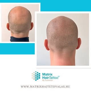 💯✅👍Páciensünk hajtetoválásának eredménye hátulról is jól látható, kiemelve a természetes megjelené