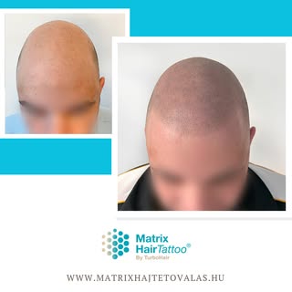 😉👌Két páciensünk hajtetoválásának eredménye szemből látható, kiemelve a természetes hajvonal és a 