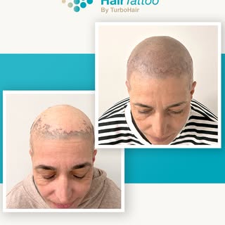 ✨ Hajtetoválás lime-kóros hajhullás után? IGEN!
Anita éveken át küzdött a lime-kór egyik legnehezebb