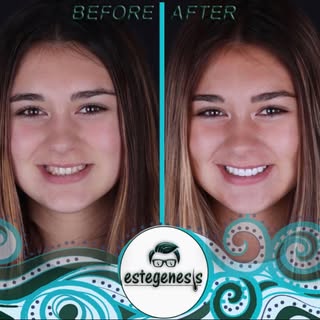 Estegenesis dental treatments 
20 laminate veneer  25 age 
🇨🇭 Switzerland. Patient