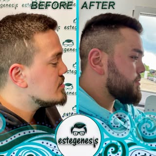 🇩🇪He had come from Germany for the beard transplant, and the result was excellent. Even he couldn’
