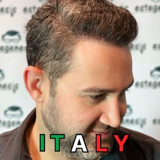 🇮🇹He came from Italy for a hair transplant and ended up with a great head of hair.  #rome #milano 