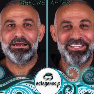 Spain🇪🇸 Age: 56 
14 implant 
28 Zirconium
Result : He is very happy right now
#madrid #barcelona #