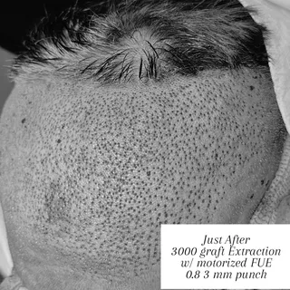 24 hours after extracting 3,000 grafts, the donor area already shows excellent healing. During extra