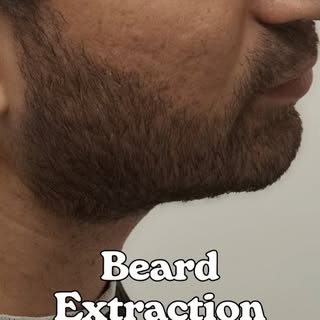 Beard hair is a valuable donor source frequently used in hair transplantation.

However, beard extra