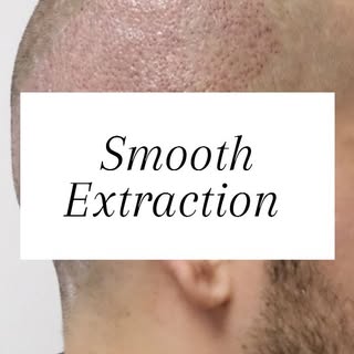 Hair extraction is not just a step — it’s the foundation of the result.
A successful hair transplant
