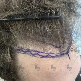 Quality reveals itself.

You are currently seeing the result at 2 weeks after the hair transplant — 